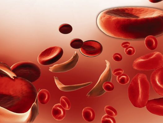 Anemia