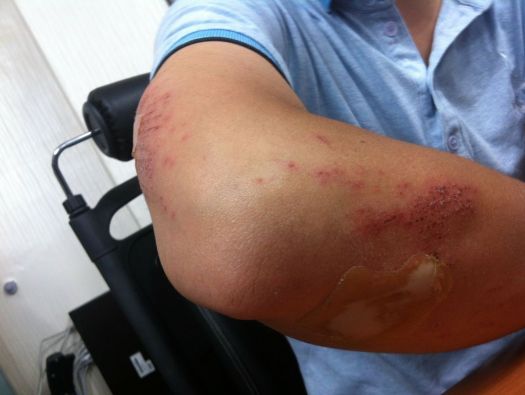 Hematoma