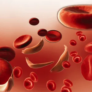 Anemia